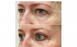 Blefaroplastia ce înseamnă și când este recomandată