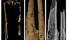 Prima amputare chirurgicală datează din urmă cu 31000 de ani studiu