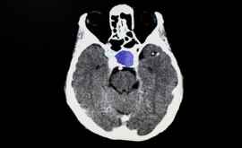 A fost descoperită modalitatea de recuperare după un accident vascular cerebral 